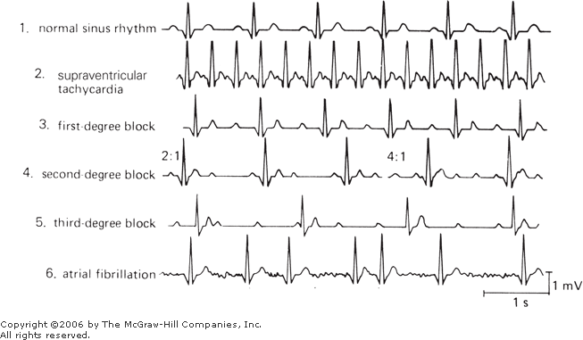 Chapter 5_ Cardiac Abnormalities | Cardiovascular Physiology: Mosby ...